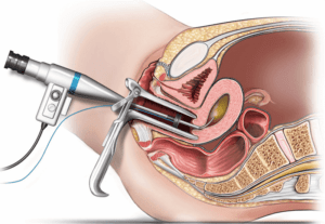 D & C – Dilatation and Curettage