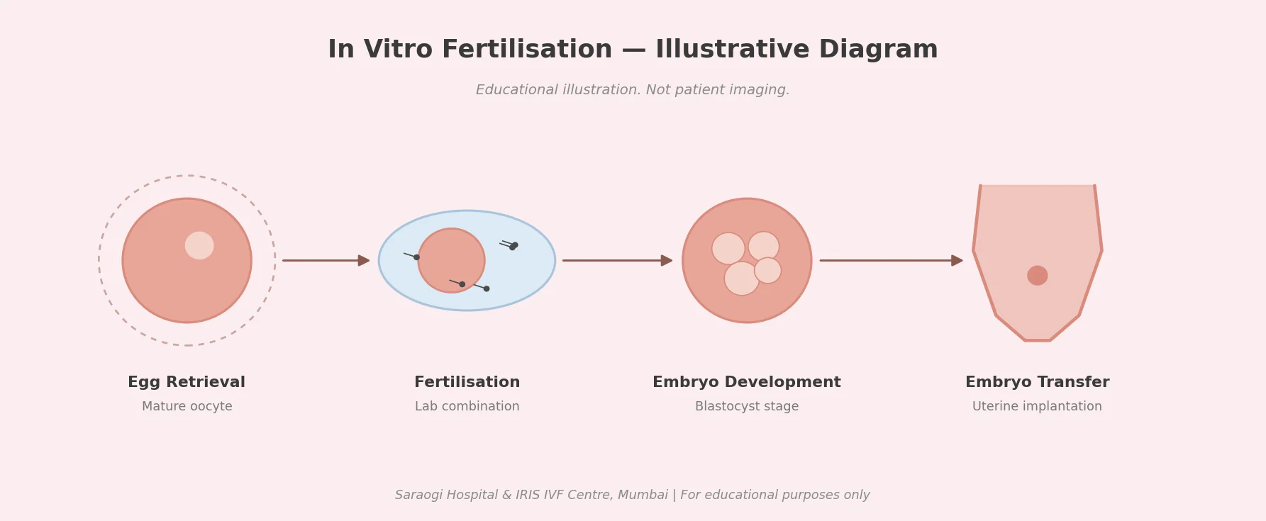 ivf_diagram_image - Saraogi Hospital Educational IVF diagram showing stages: egg retrieval, fertilisation, embryo development, and embryo transfer to the uterus on pink background.