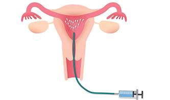 IUI Cost in mumbai