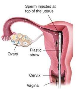 IUI or Intrauterine Insemination