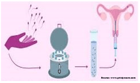 Insemination Procedure - IUI Tretment