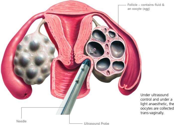 Ovum Pick up/ Oocyte collection