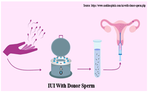 IUI with donor sperm