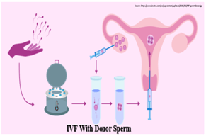 IVF with donor sperm