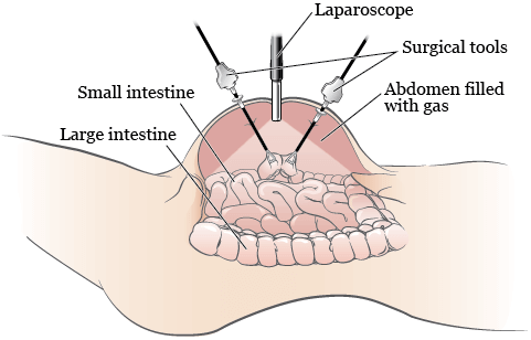 laparoscopyf2