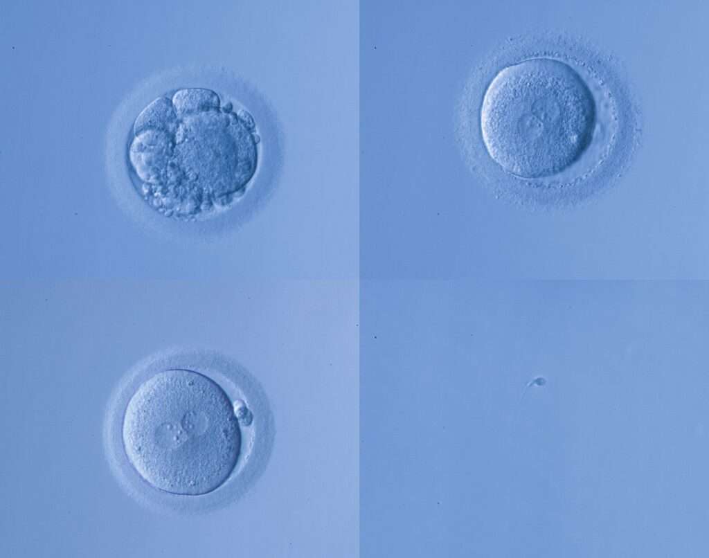 multiple embryo transfer