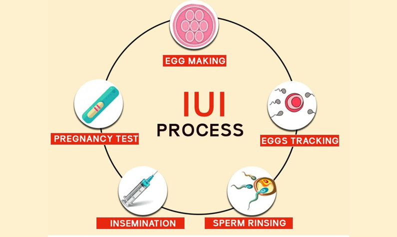 IUI Procedure