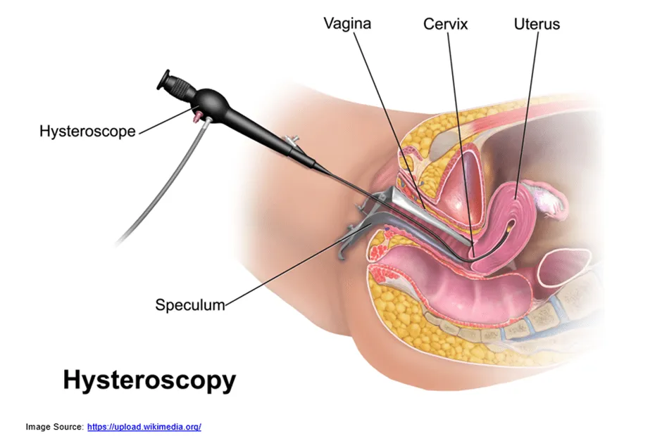 Pregnancy success after hysteroscopy 