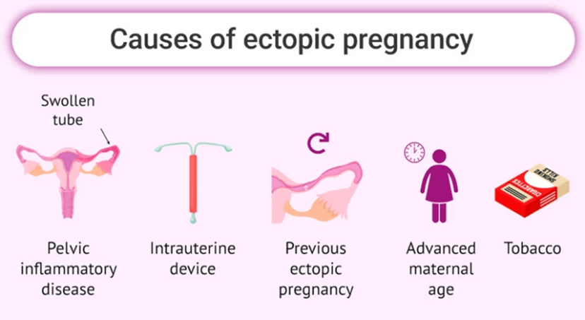 Ectopic Pregnancy  Signs, Symptoms, Causes, & Treatments