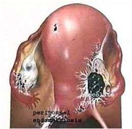 chocolate cysts of the ovary