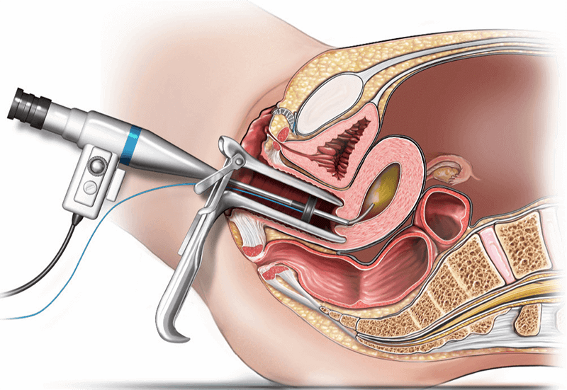 hysteroscopic