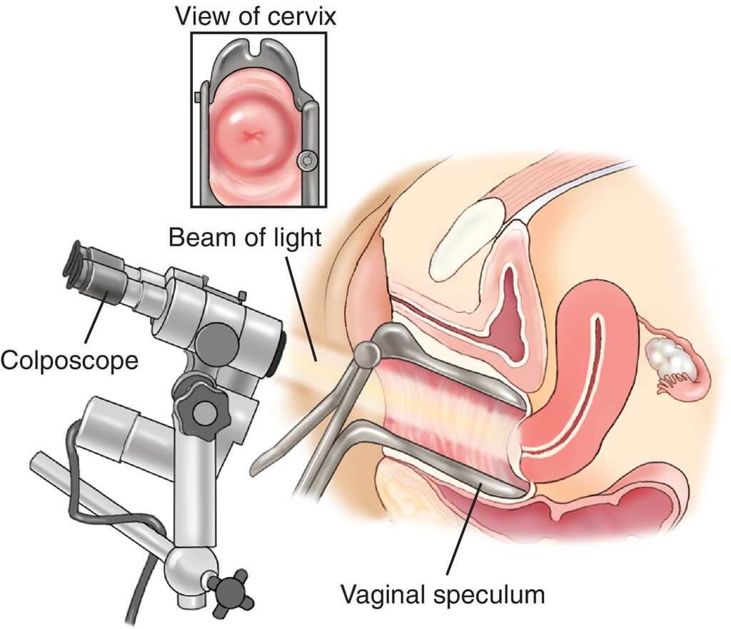 Colposcopy Services