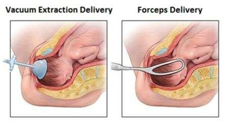 Epidural analgesia