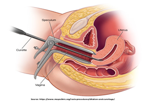 Surgical Abortion