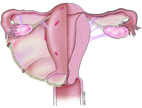 Endometriosis