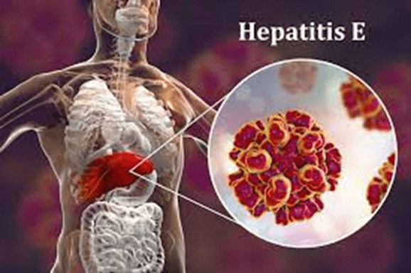 hepatitis E 1