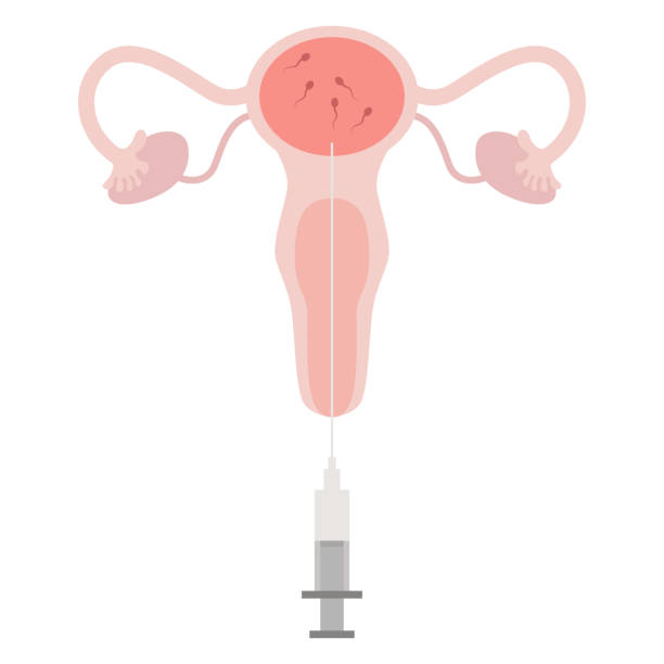 Intrauterine Insemination (IUI)