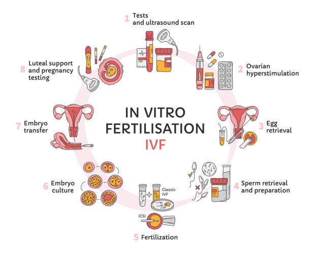 What is IVF