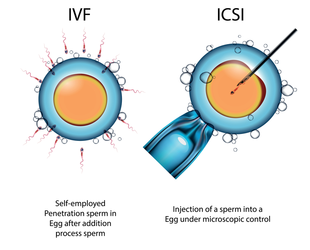 icsi