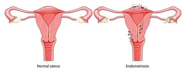 What is Endometriosis
