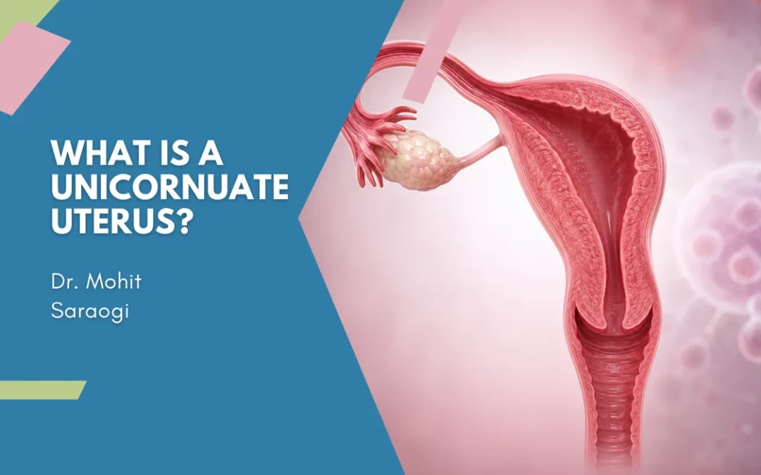 What Is a Unicornuate Uterus