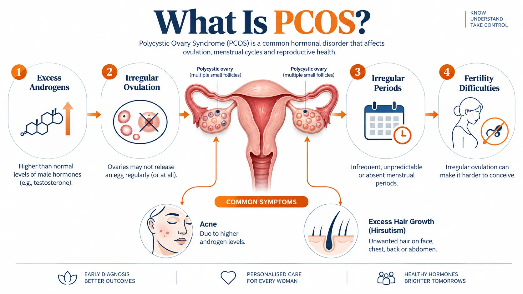 image5 - Saraogi Hospital Infographic explaining PCOS: four steps from excess androgens to fertility difficulties.